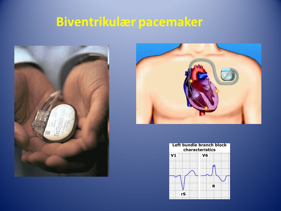 Biventrikulær pacemaker