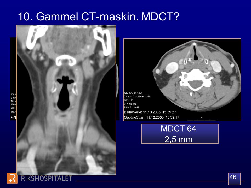 10. Gammel CT-maskin. MDCT Spiral-CT 3 mm MDCT 64 2,5 mm 46