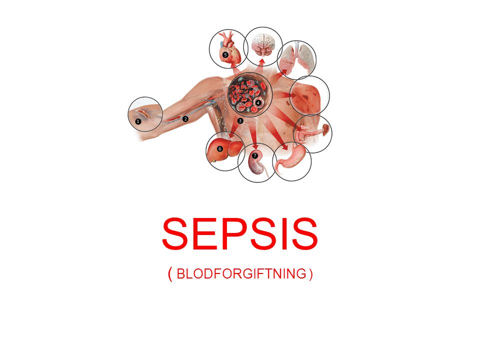 SEPSIS ( BLODFORGIFTNING )