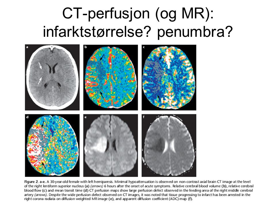 CT-perfusjon (og MR): infarktstørrelse penumbra