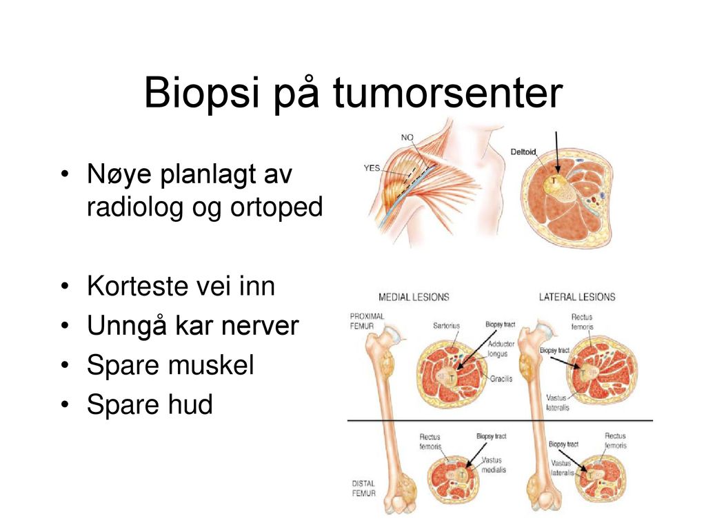 Biopsi på tumorsenter Nøye planlagt av radiolog og ortoped