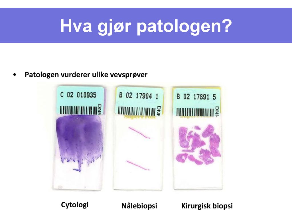 Hva gjør patologen Patologen vurderer ulike vevsprøver Cytologi