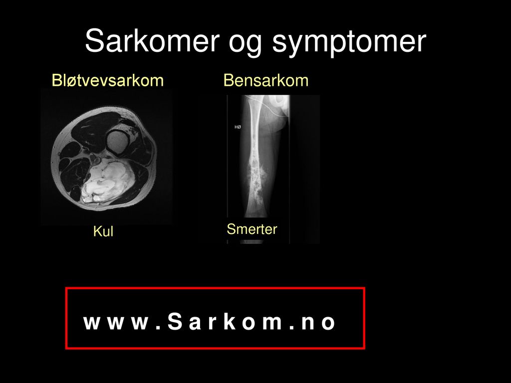 Sarkomer og symptomer w w w . S a r k o m . n o Bløtvevsarkom