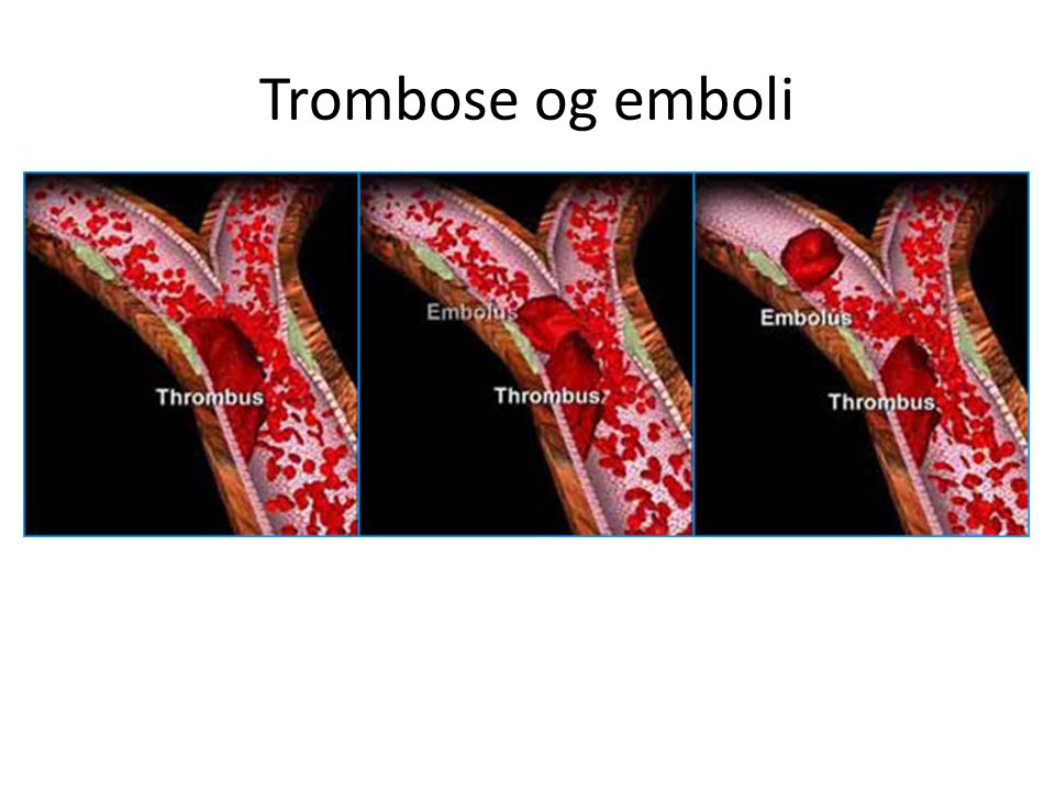 Trombose og emboli