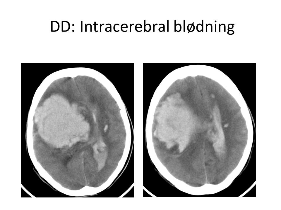 DD: Intracerebral blødning