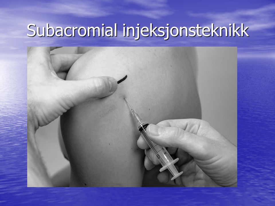 Subacromial injeksjonsteknikk