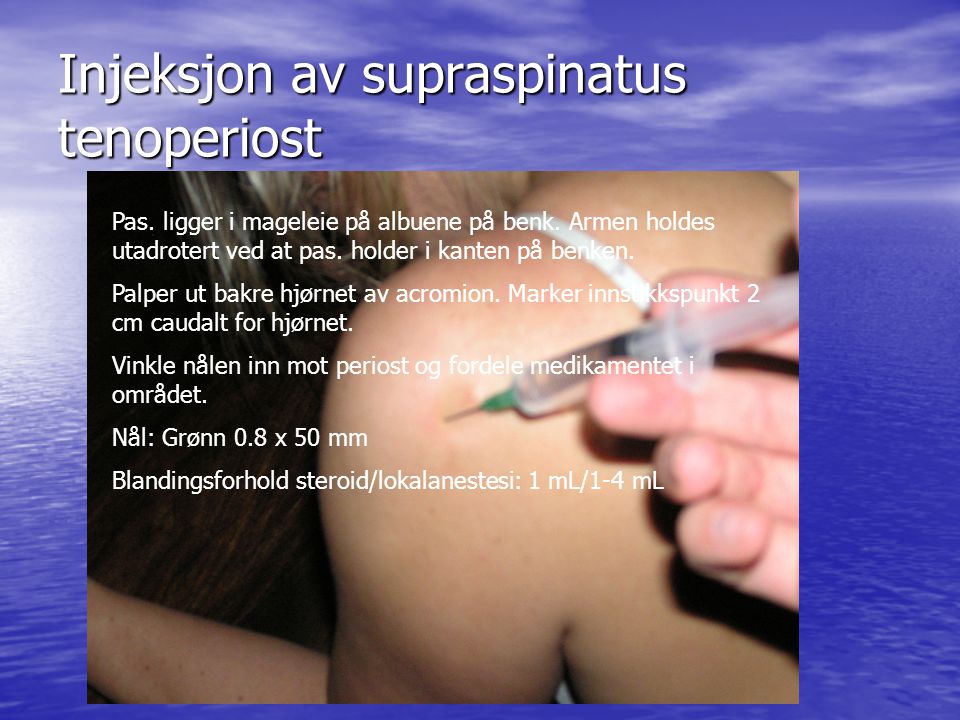 Injeksjon av supraspinatus tenoperiost