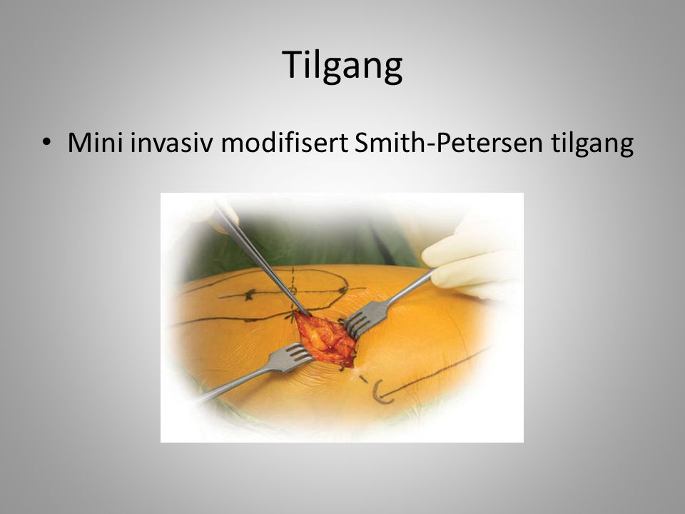 Tilgang Mini invasiv modifisert Smith-Petersen tilgang