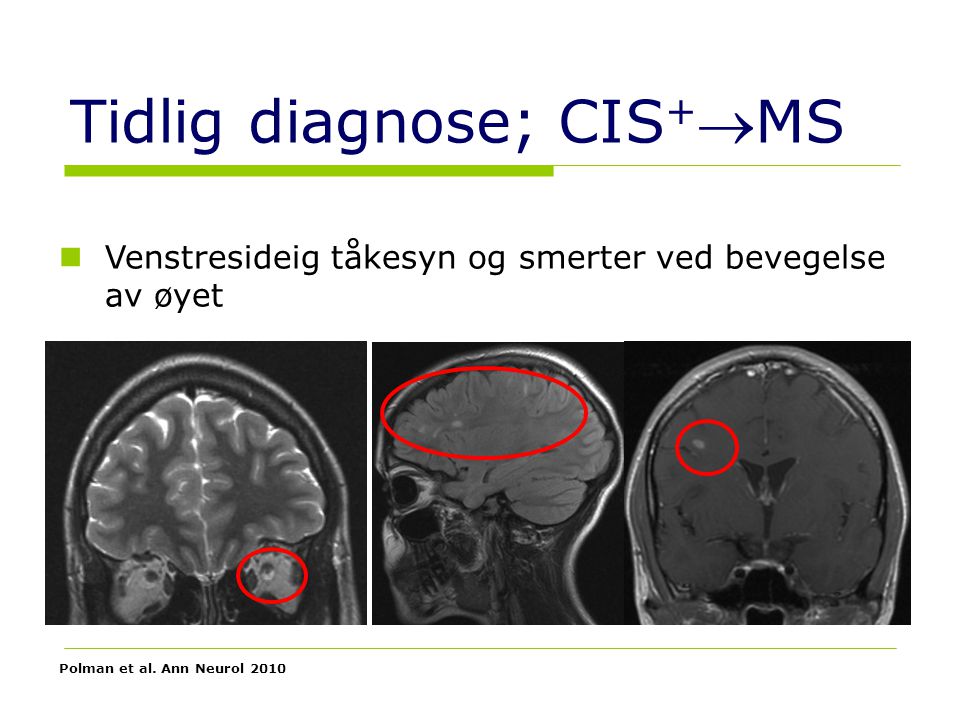 Tidlig diagnose; CIS+MS