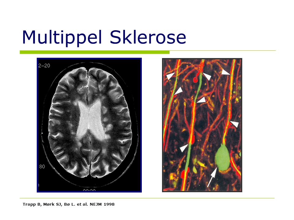 Multippel Sklerose Trapp B, Mørk SJ, Bø L. et al. NEJM 1998