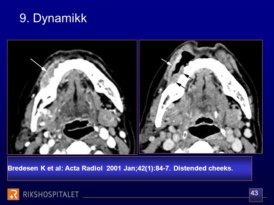 9. Dynamikk Bredesen K et al: Acta Radiol 2001 Jan;42(1):84-7. Distended cheeks. 43
