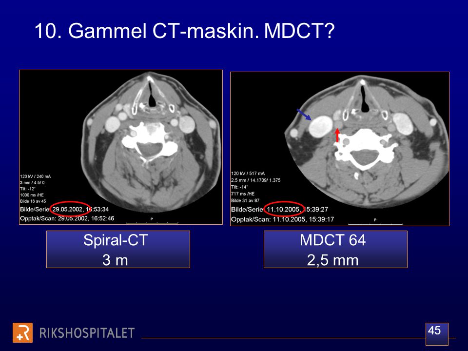 10. Gammel CT-maskin. MDCT Spiral-CT 3 m MDCT 64 2,5 mm 45