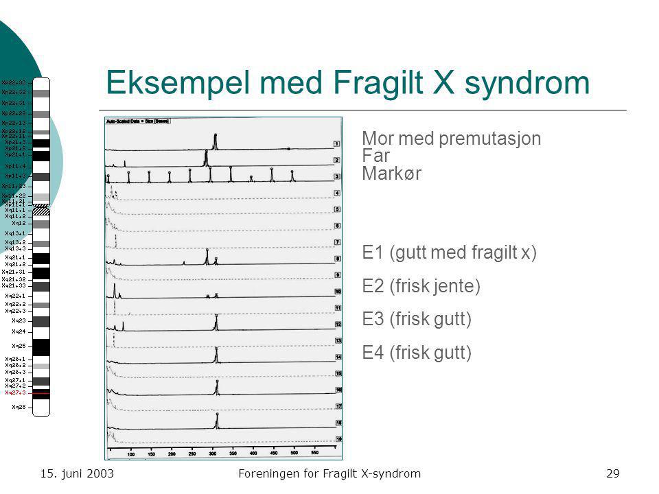 Eksempel med Fragilt X syndrom