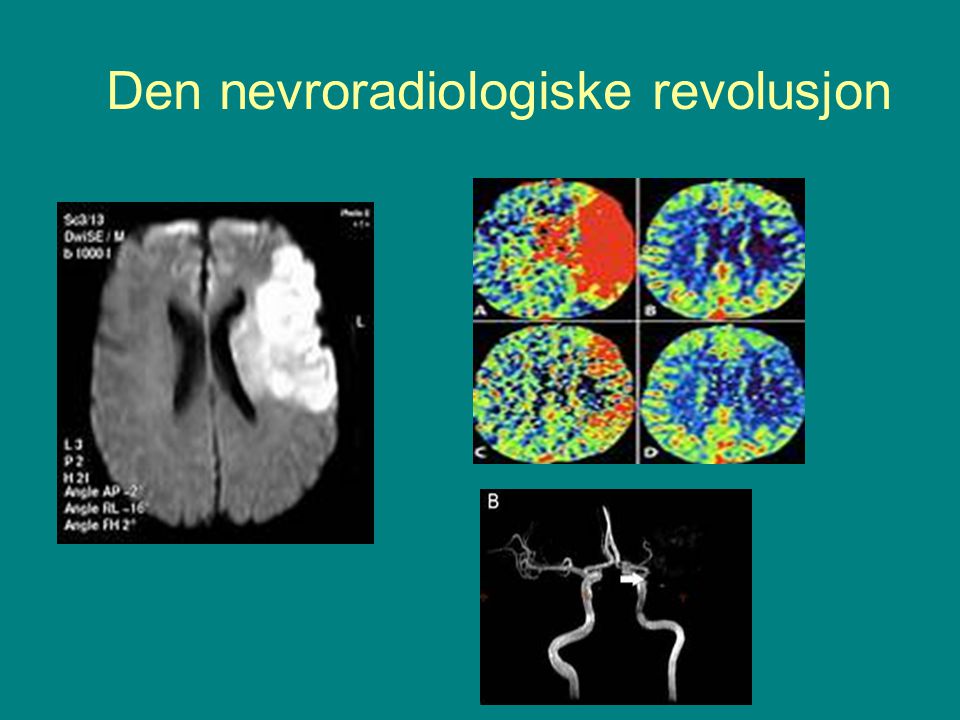 Den nevroradiologiske revolusjon