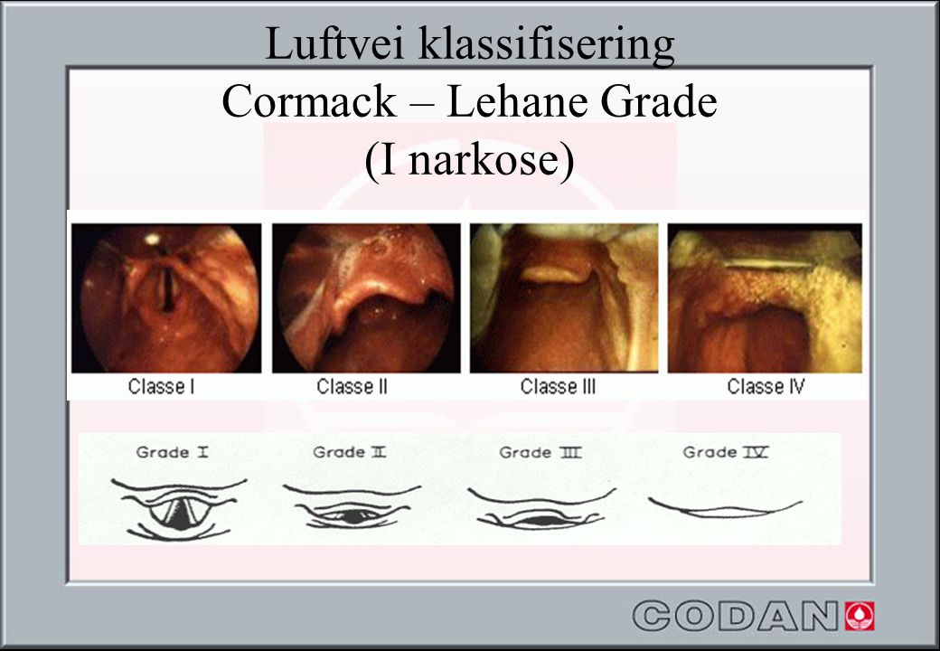 Luftvei klassifisering Cormack – Lehane Grade (I narkose)