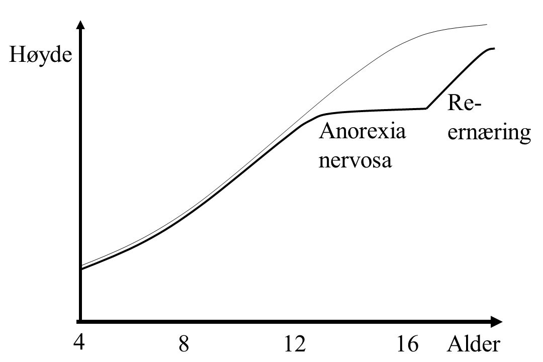 Høyde Re- ernæring Anorexia nervosa Alder