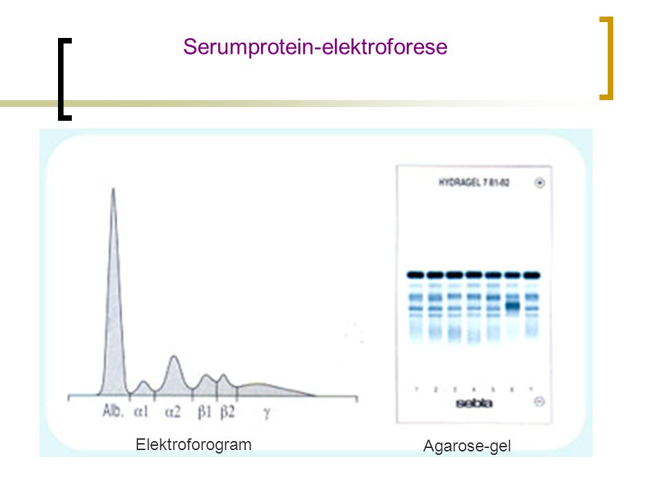 Serumprotein-elektroforese