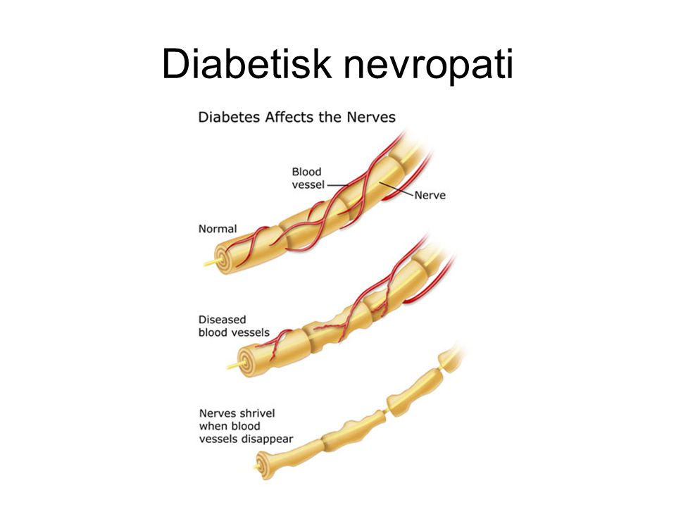 Diabetisk nevropati
