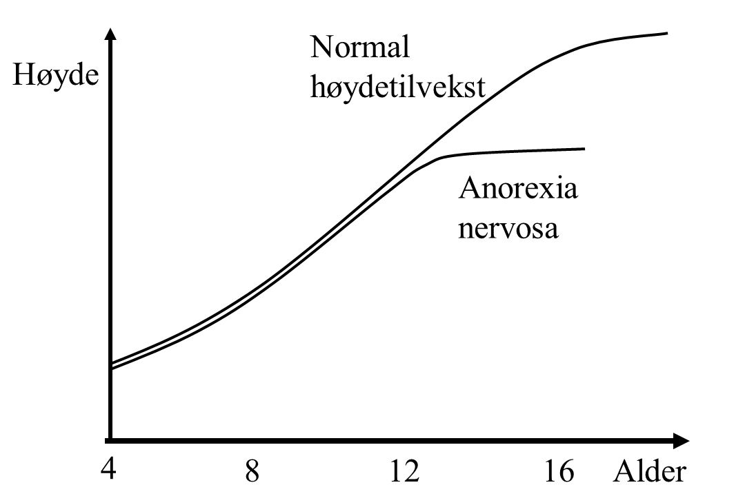 Normal høydetilvekst Høyde Anorexia nervosa Alder