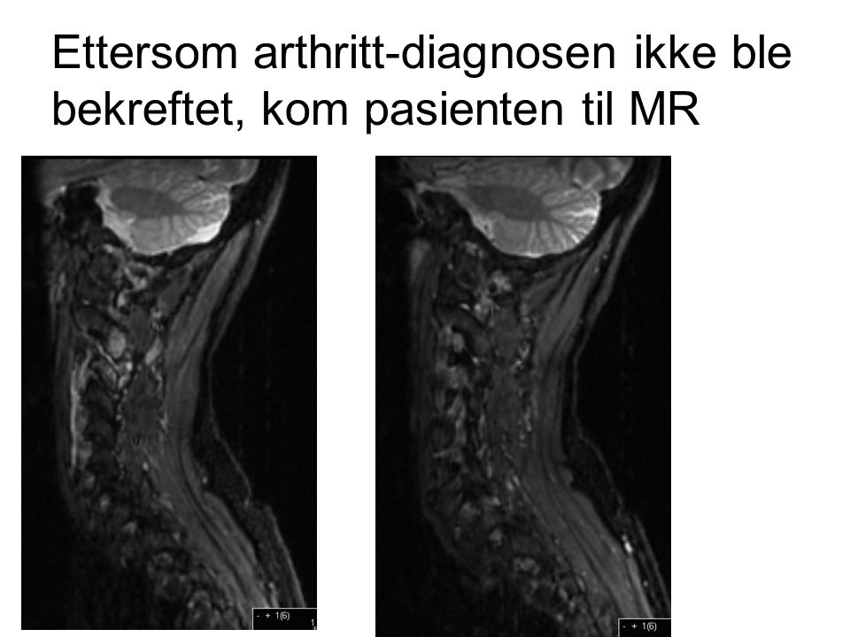 Ettersom arthritt-diagnosen ikke ble bekreftet, kom pasienten til MR