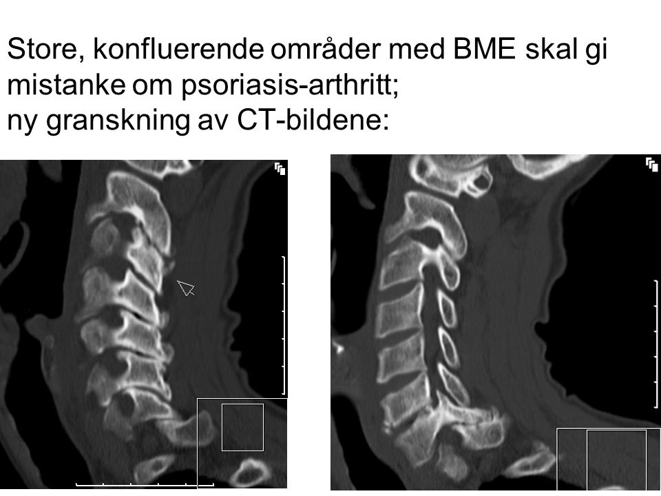 Store, konfluerende områder med BME skal gi mistanke om psoriasis-arthritt; ny granskning av CT-bildene:
