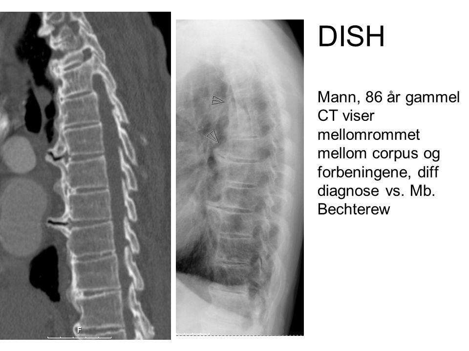 DISH Mann, 86 år gammel CT viser mellomrommet mellom corpus og forbeningene, diff diagnose vs. Mb. Bechterew
