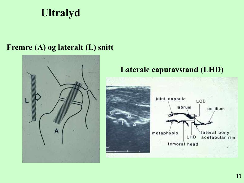 Ultralyd Fremre (A) og lateralt (L) snitt Laterale caputavstand (LHD)