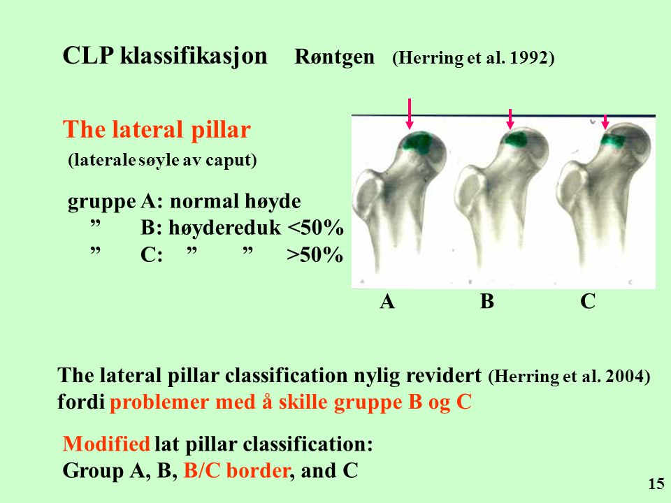 CLP klassifikasjon Røntgen (Herring et al. 1992)