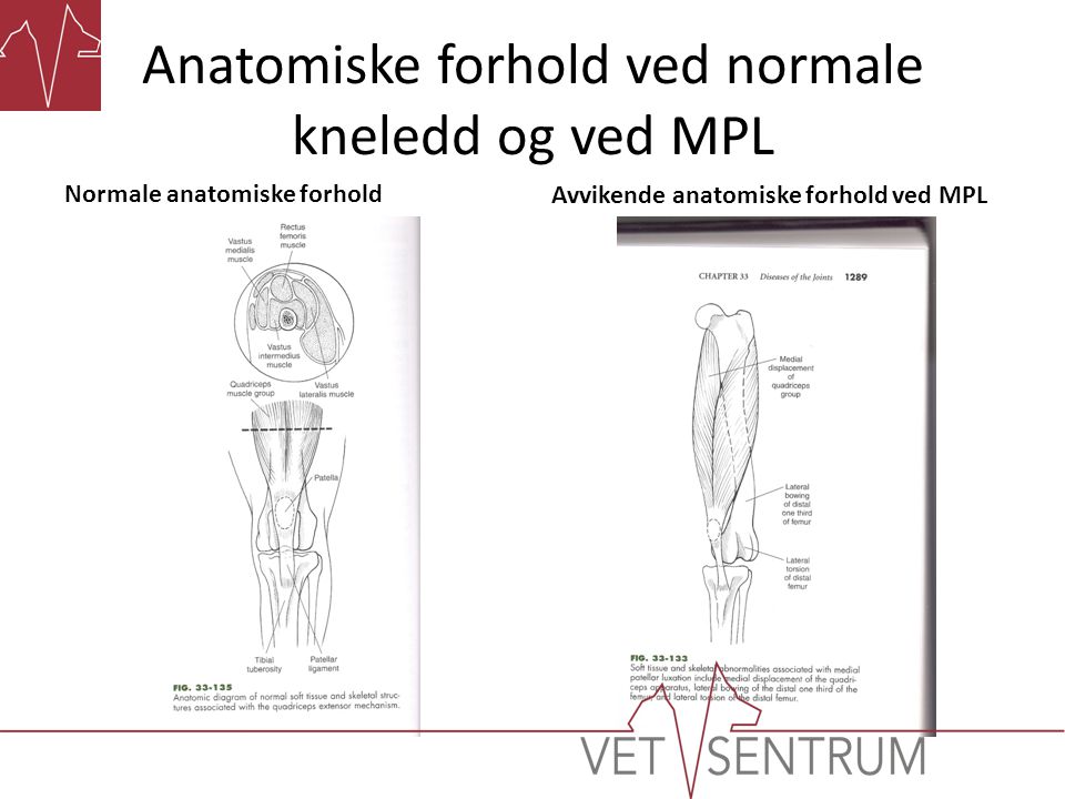 Anatomiske forhold ved normale kneledd og ved MPL