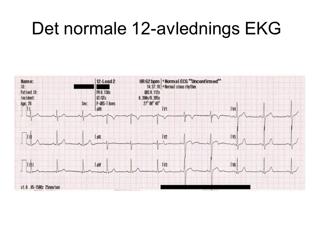 Det normale 12-avlednings EKG