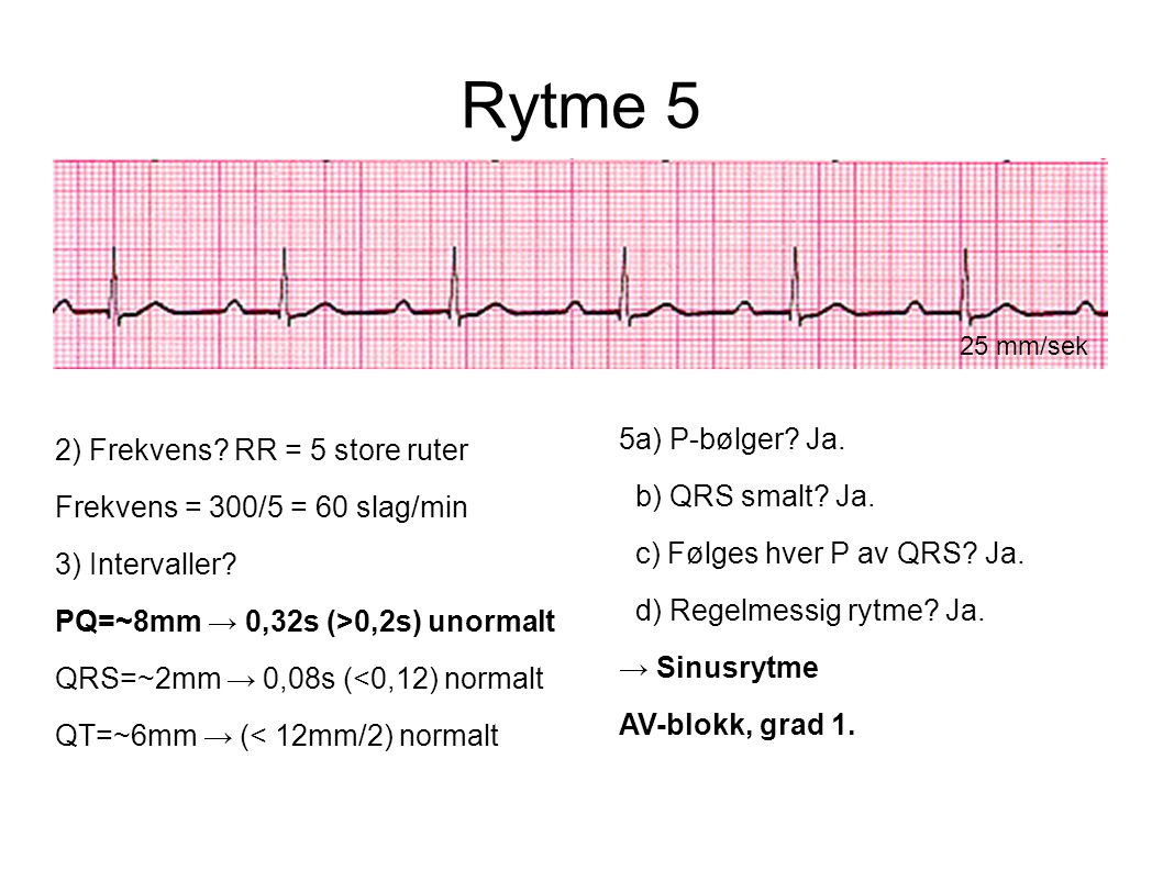 Rytme 5 5a) P-bølger Ja. 2) Frekvens RR = 5 store ruter