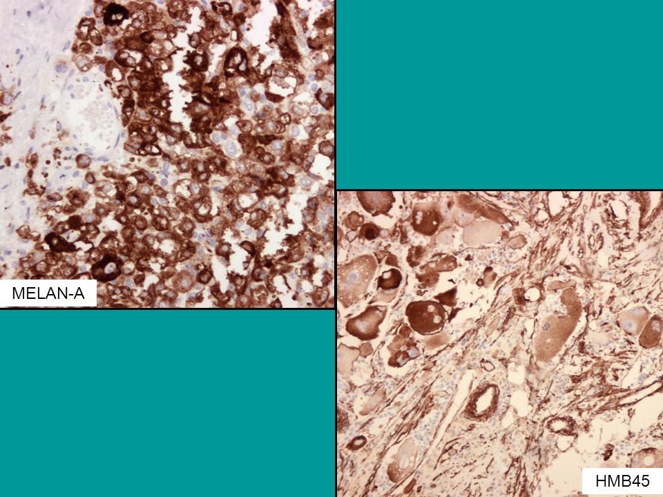 MELAN-A IHjkemisk var tumorcellene positive på melan-a, hmb45 HMB45