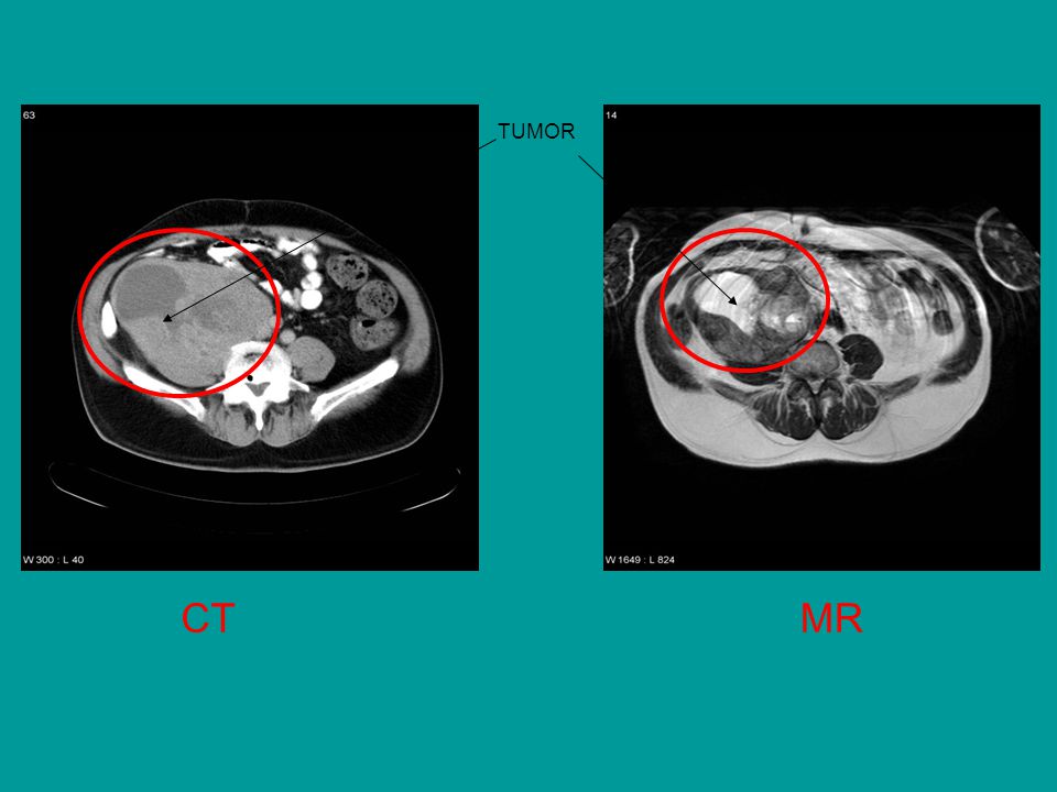 TUMOR Her er CT og MR bilder hvor det sees tydelig stor patolog. Oppfylning i hø. flanke CT MR