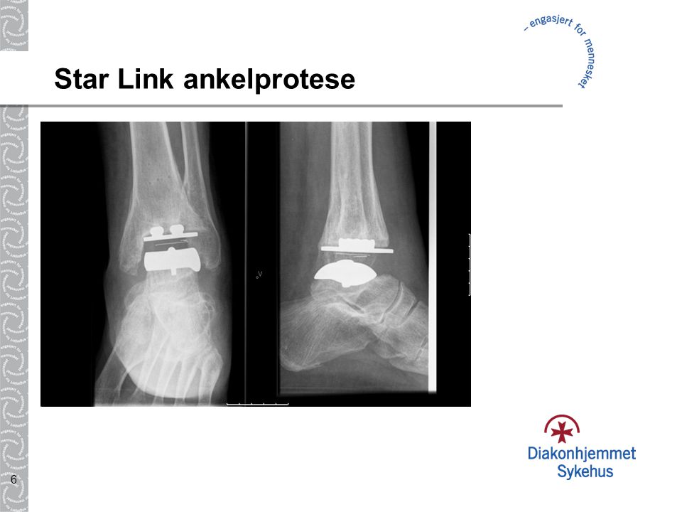 Star Link ankelprotese