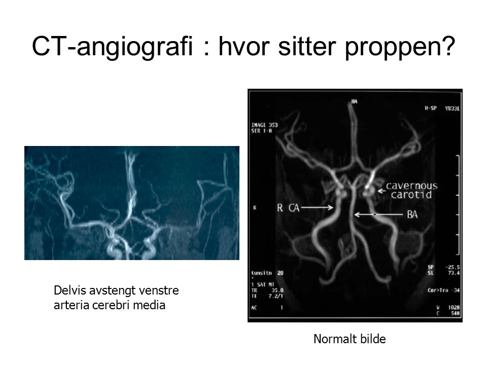 CT-angiografi : hvor sitter proppen