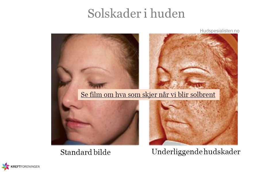Solskader i huden Standard bilde Underliggende hudskader