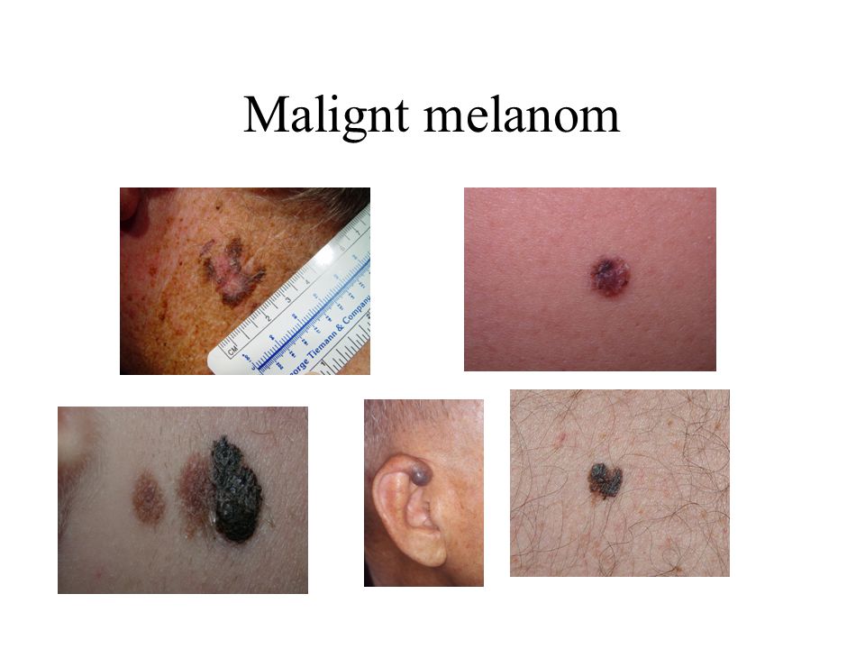 Malignt melanom