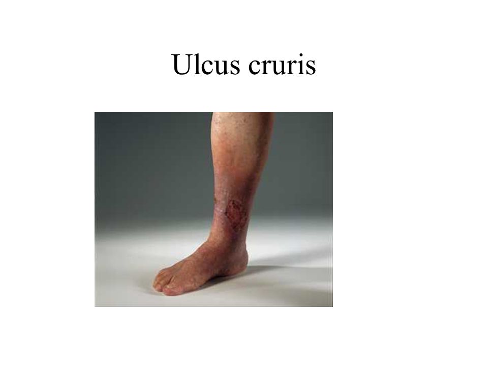 Ulcus cruris