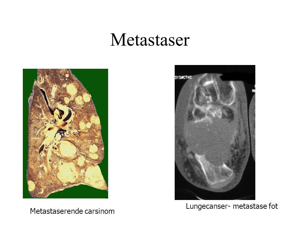 Metastaser Lungecanser- metastase fot Metastaserende carsinom