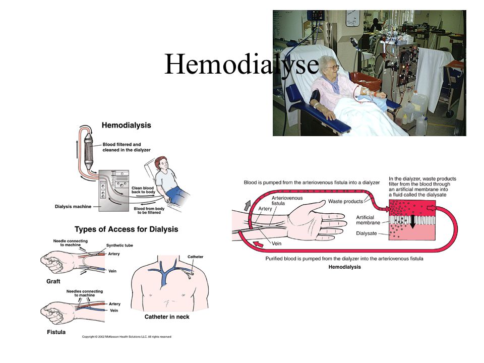 Hemodialyse