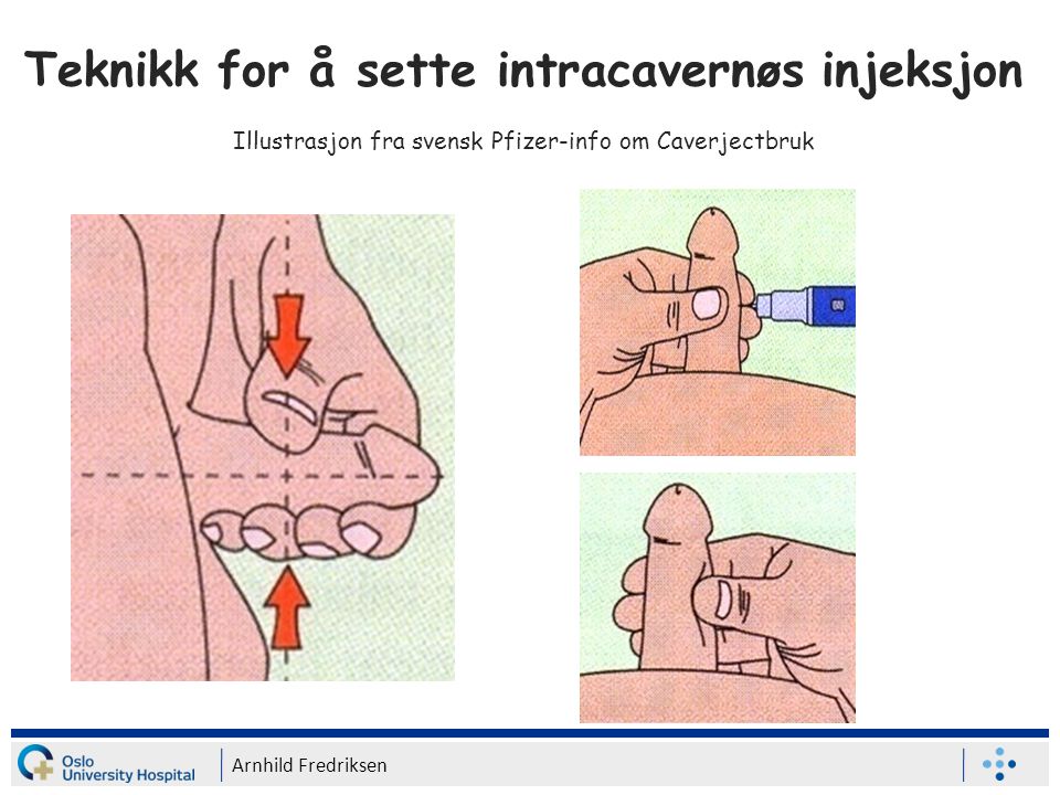 Teknikk for å sette intracavernøs injeksjon Illustrasjon fra svensk Pfizer-info om Caverjectbruk