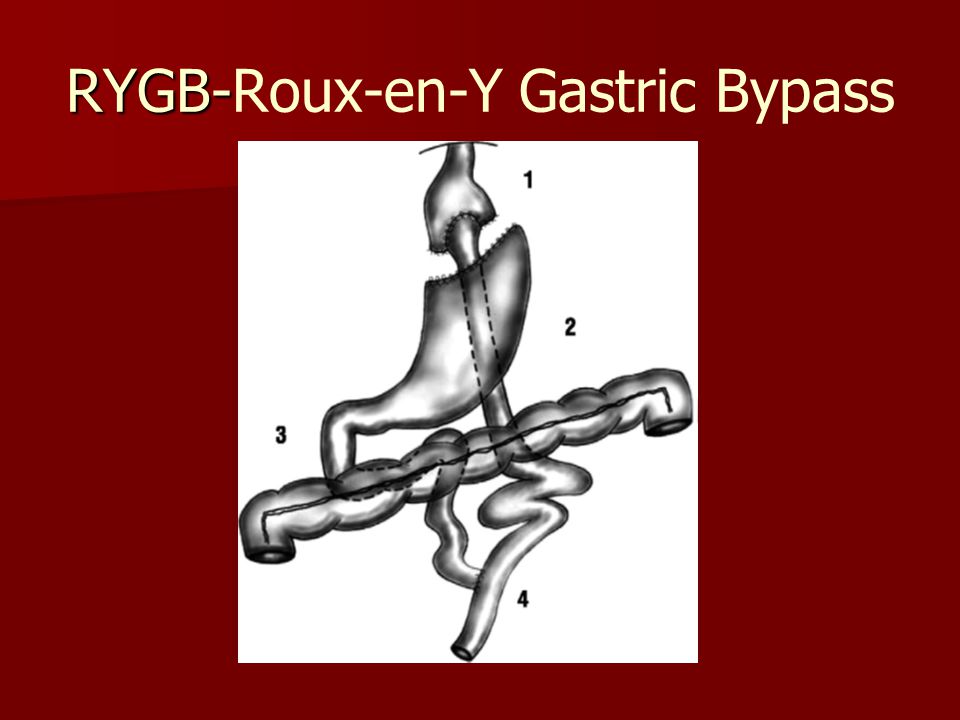 RYGB-Roux-en-Y Gastric Bypass